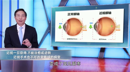 眼科专家透露真相:近视手术不能治愈近视!